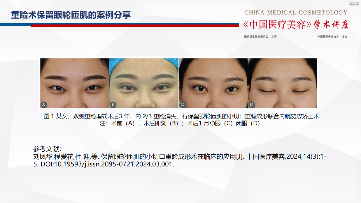 重瞼術(shù)4.png